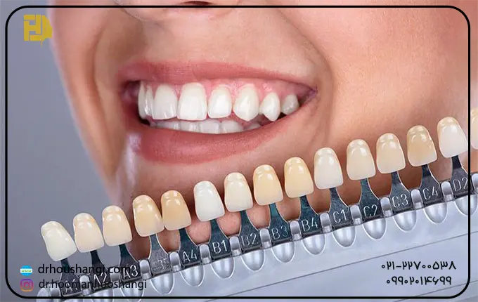عوامل موثر بر تغییر رنگ تاج های دندان مصنوعی