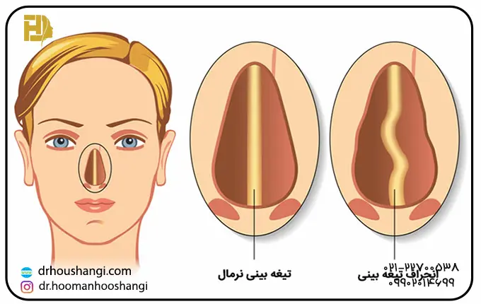 علائم و عوارض انحراف تیغه بینی