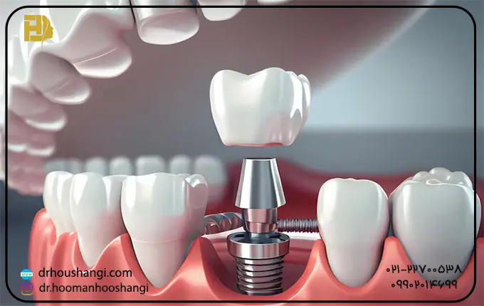 آیا کاشت ایمپلنت دندان آسیاب اجباری است؟