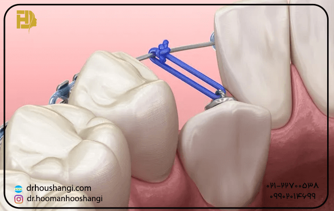 جراحی دنتوآلوئولار دندان