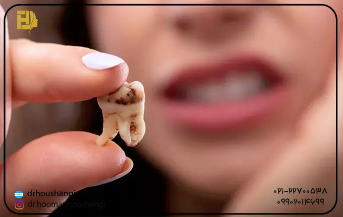 علل شایع دندان‌های نهفته