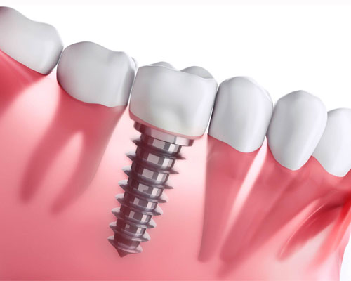 نکاتی درباره ایمپلنت دندان- بخش دوم