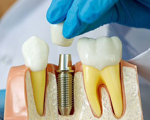 نکاتی درباره ایمپلنت دندان- بخش چهارم