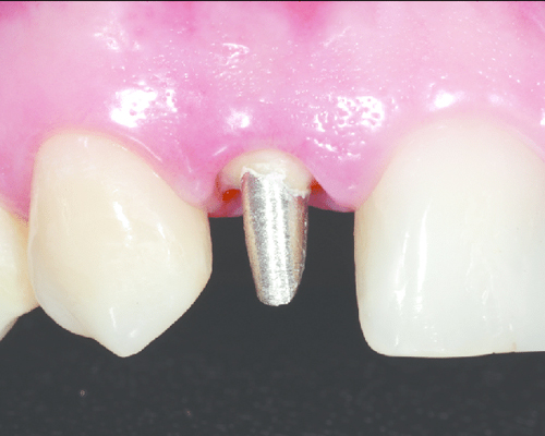 بازسازی دندان عصب کشی شده