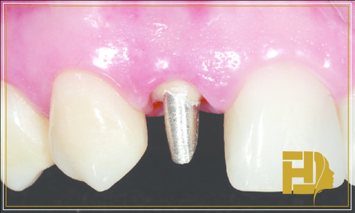 بازسازی دندان عصب کشی شده