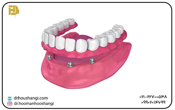 تفاوت دندان مصنوعی و اوردنچر بر پایه ایمپلنت