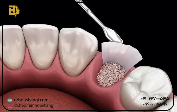 مراقبت های بعد از عمل پیوند استخوان دندان