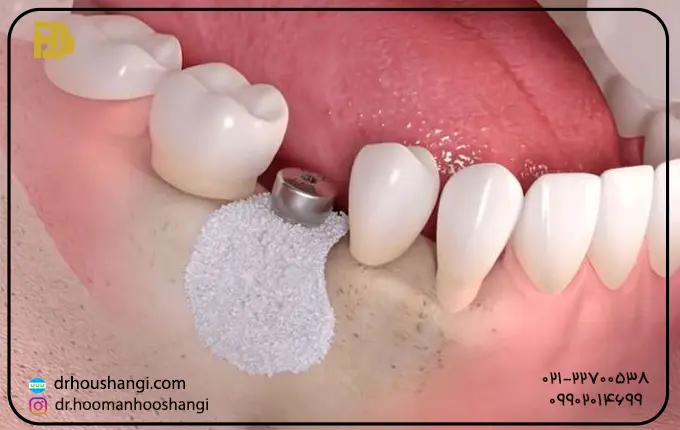 انواع مواد پیوند استخوان دندان