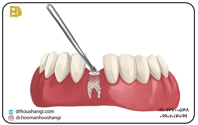 اهمیت پیوند استخوان در کاشت دندان