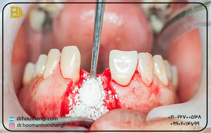 مراحل عمل پیوند استخوان دندان