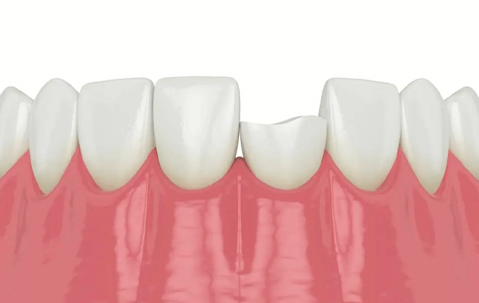 چه کسانی واجد شرایط دریافت غرامت برای دندان های شکسته هستند؟