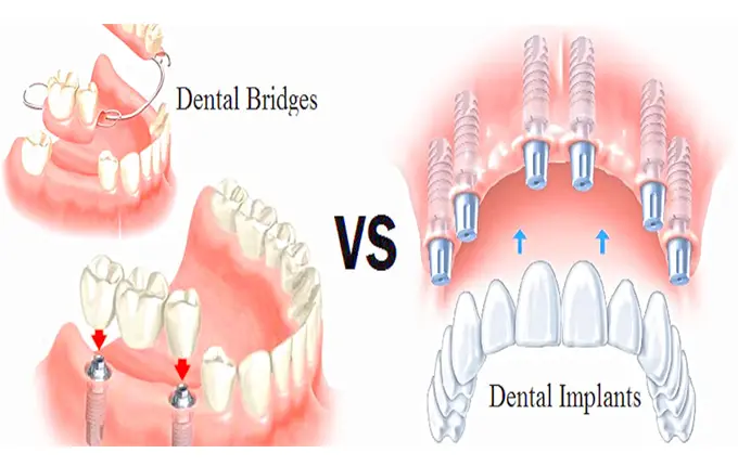 تفاوت بریج دندان و ایمپلنت