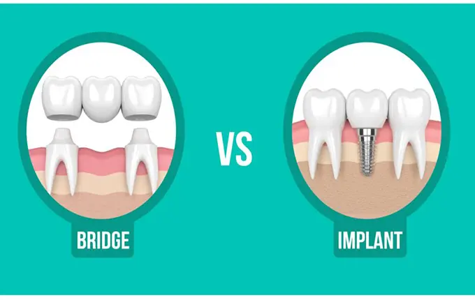 تفاوت بریج دندان و ایمپلنت