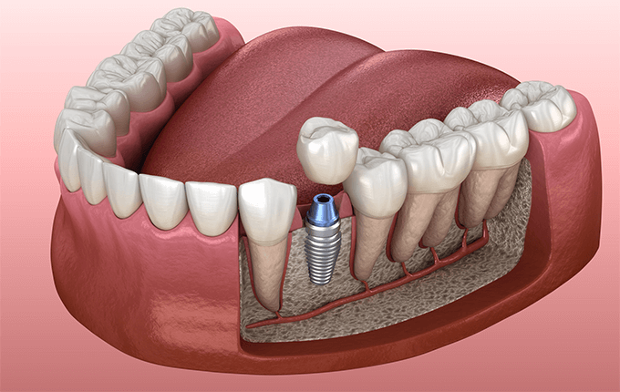 درمان دندانپزشکی برای افزایش تراکم استخوان