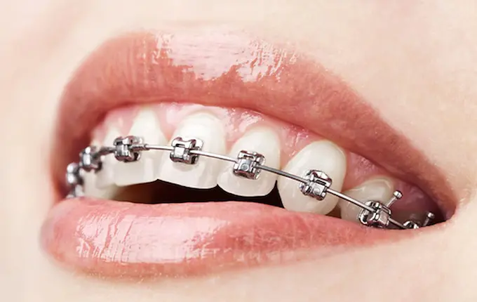 چرا باید قبل یا بعد ایمپلنت دندان ارتودنسی انجام داد؟ 