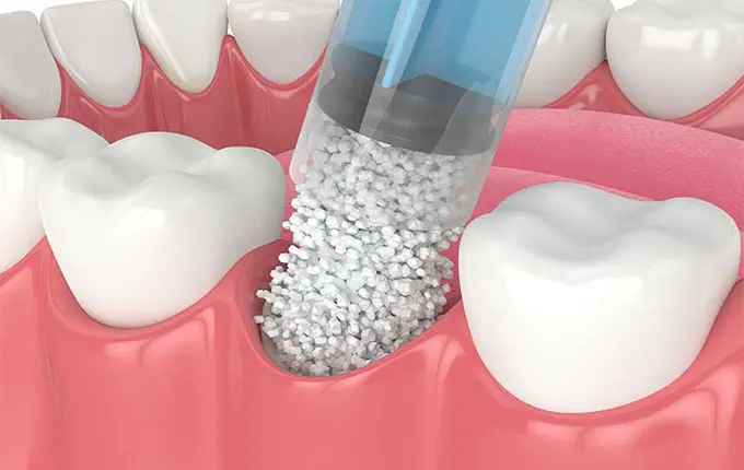 انتخاب بهترین پودر پیوند استخوان برای ایمپلنت های دندانی