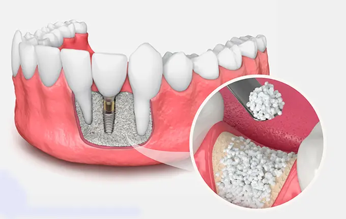 آشنایی با انواع مواد پیوند استخوان در دندانپزشکی