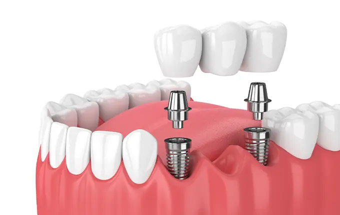 علائم شکست ایمپلنت دندان با استفاده از پودر پیوند استخوان