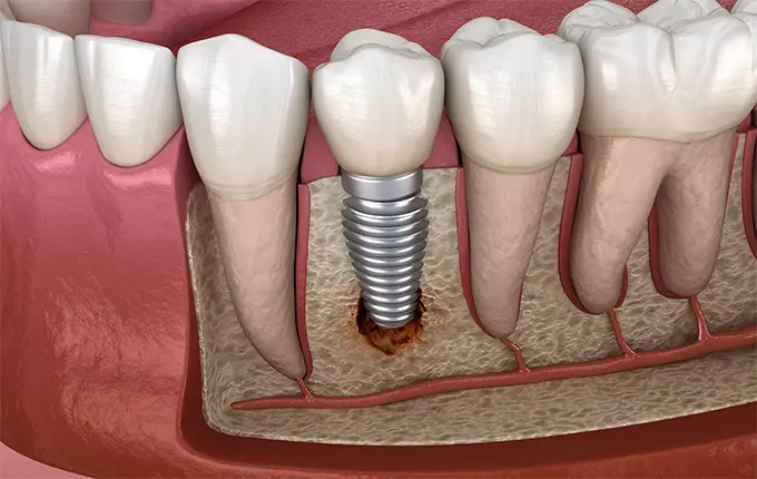 اقدامات پیشگیرانه برای جلوگیری از عوارض احتمالی ایمپلنت های دندانی
