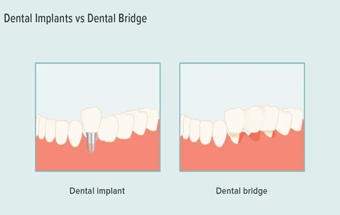  7 مزیت ایمپلنت دندان نسبت به بریج های دندانی