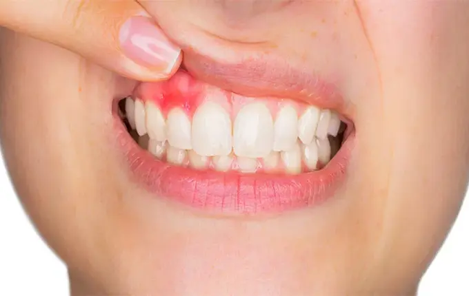 عوارض جانبی ایمپلنت های دندانی