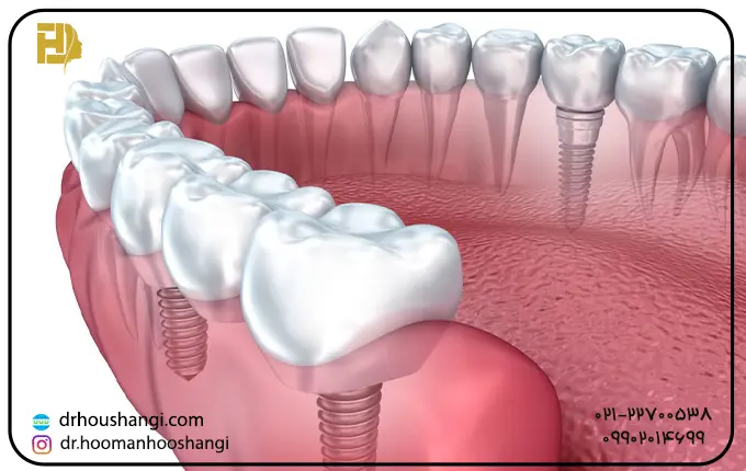 کاشت ایمپلنت دندان با استفاده از روش اندوستال 