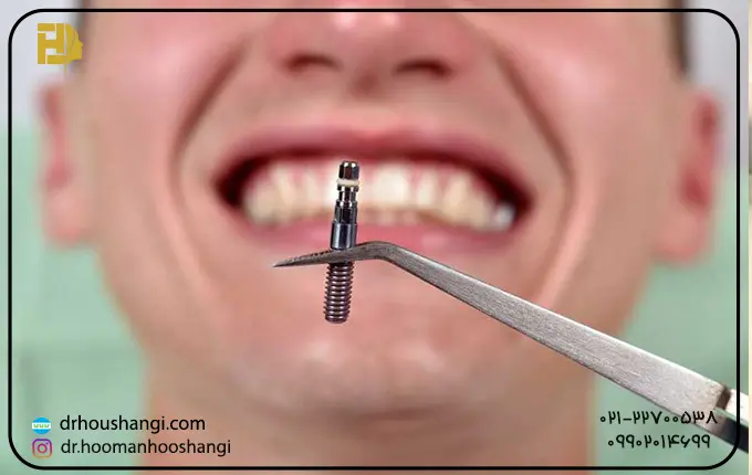 نشانه های آلرژی به ایمپلنت های دندانی تیتانیوم