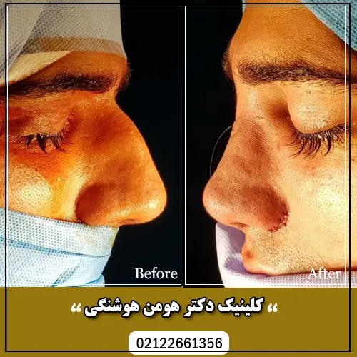 گالری قبل و بعد از جراحی بینی