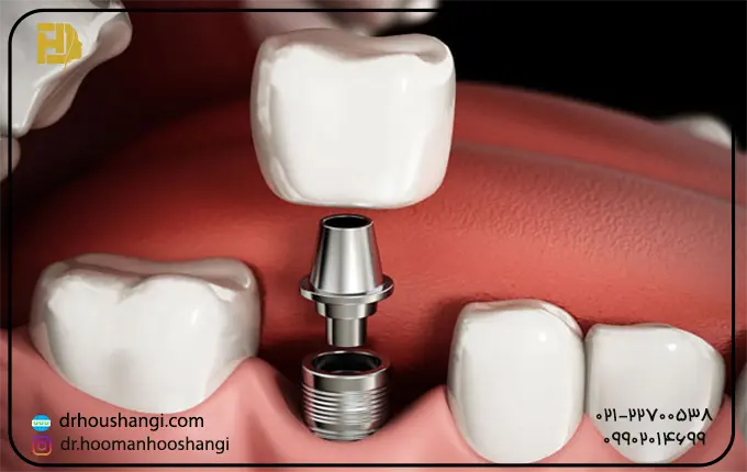 عوامل موثر در انتخاب بریج یا ایمپلنت دندان 