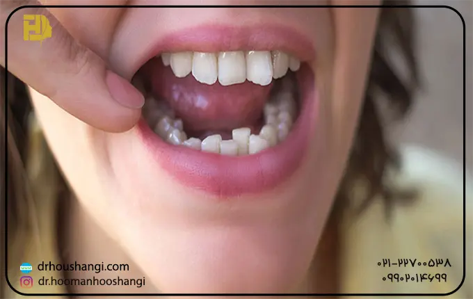 6 دلیل کج شدن دندان  