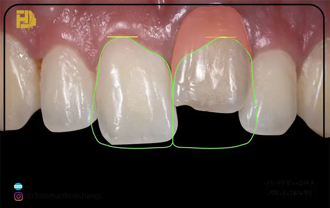 عوارض آنکیلوز دندان 