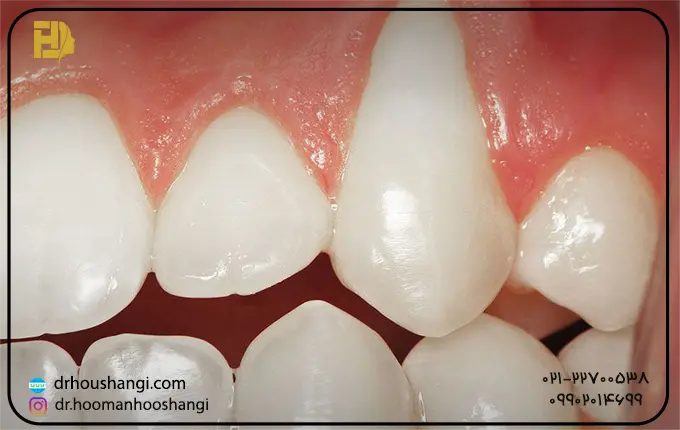 راه های تشخیص آنکیلوز دندان 