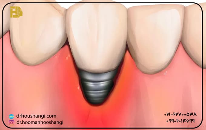 علائم عفونت ایمپلنت دندان