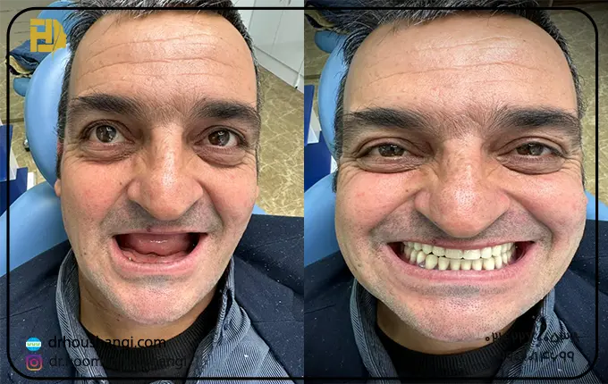ایمپلنت در تهران