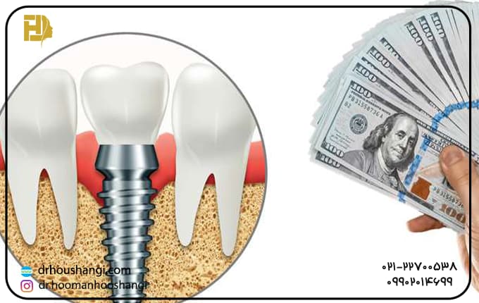 هزینه اقساطی ایمپلنت دندان چقدر است؟