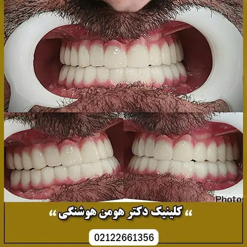 معایب ایمپلنت دندان چیست؟