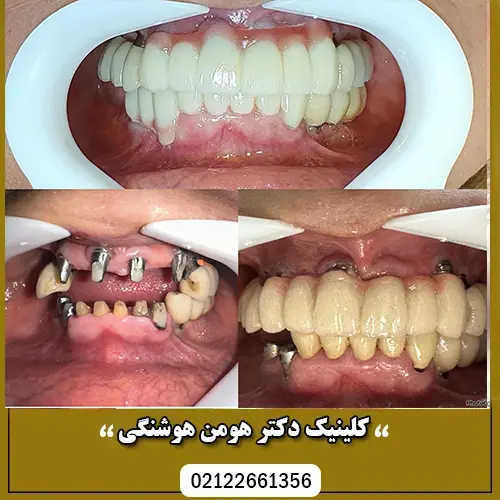 در چه شرایطی باید ایمپلنت بکاریم؟ 